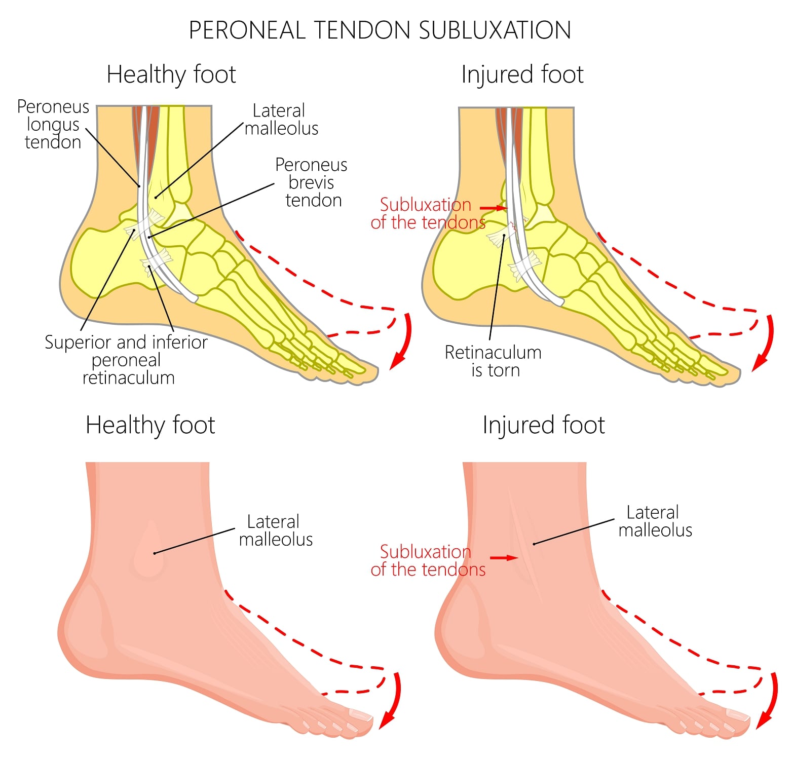 Posterior tibial tendon insufficiency
