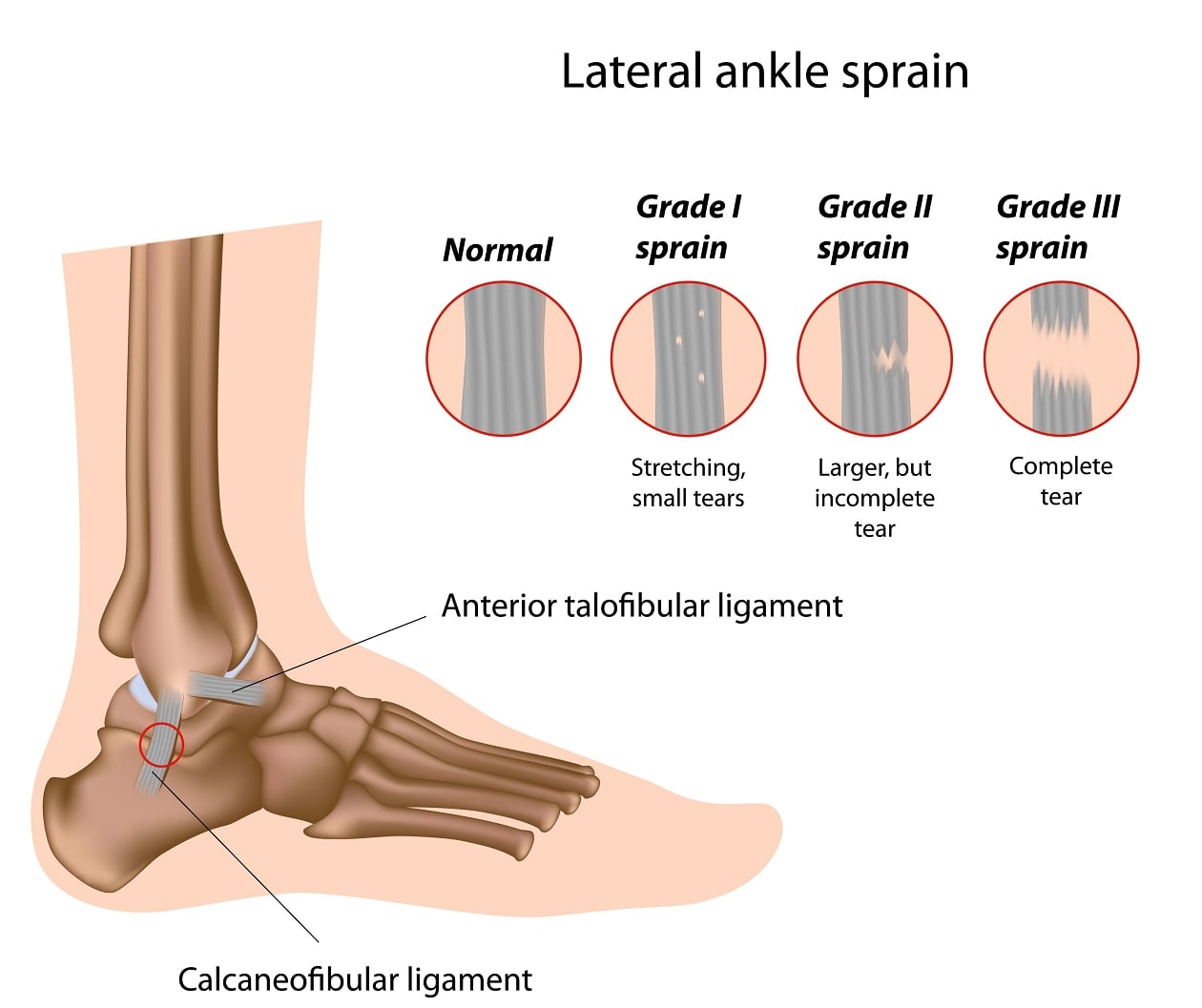 Low Ankle Sprains