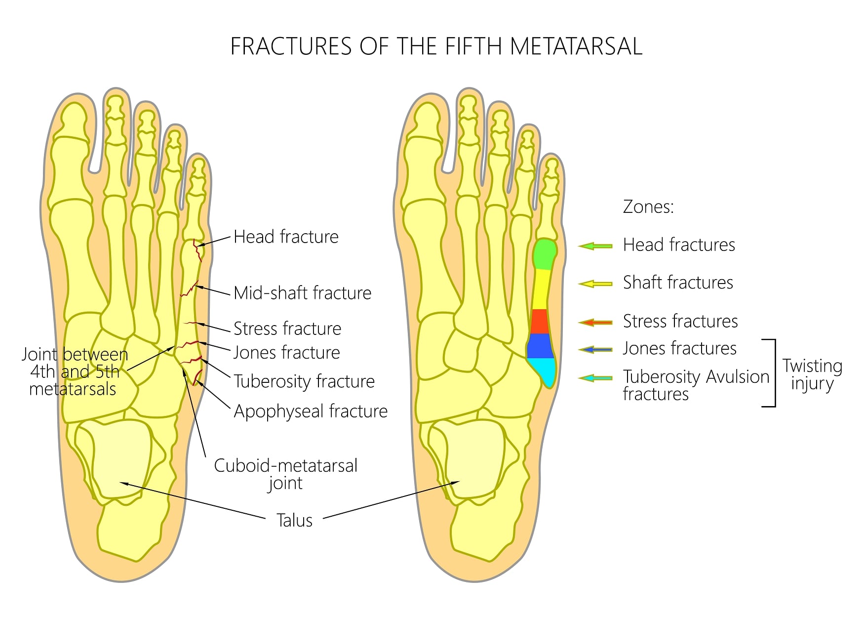 left foot 4th metatarsal fracture