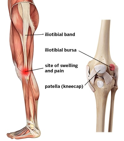 Iliotibial Band Friction Syndrome