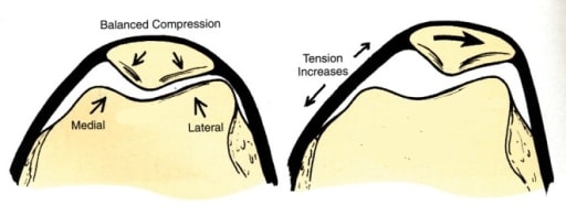 Lateral Patellar Compression Syndrome