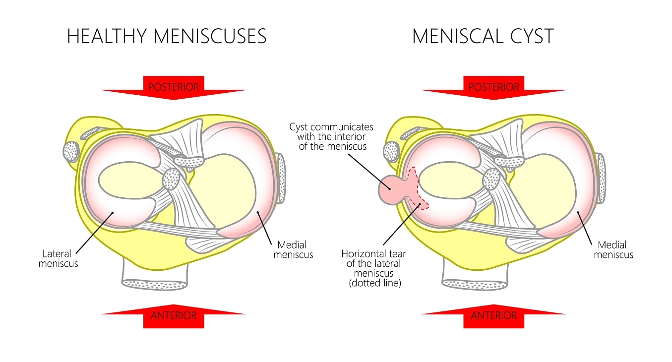 Meniscal cysts