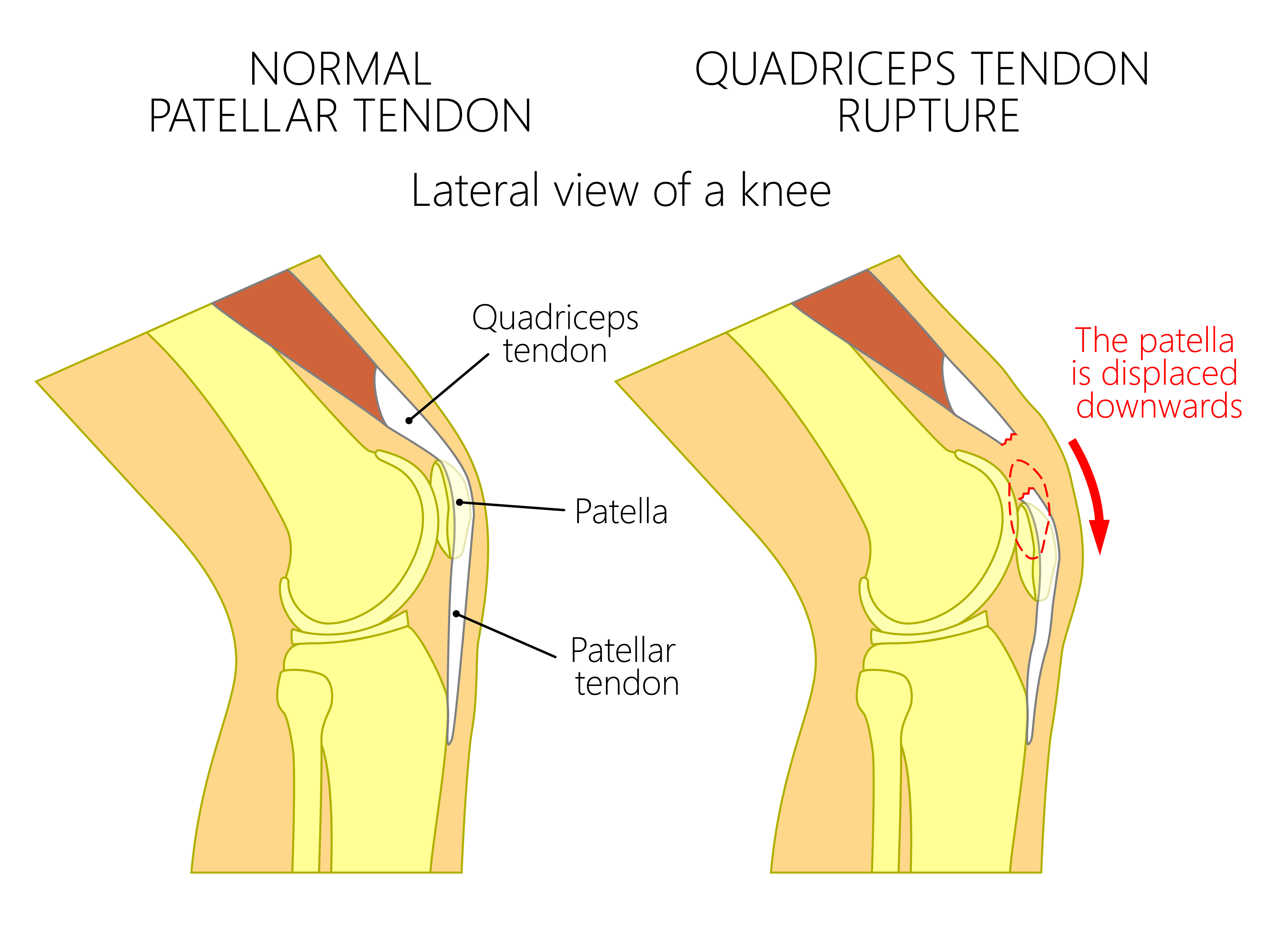 Quadriceps Tendon Rupture