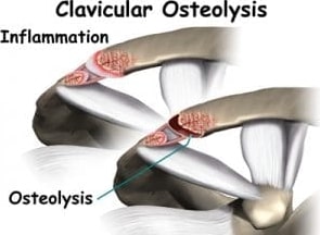 Osteolysis