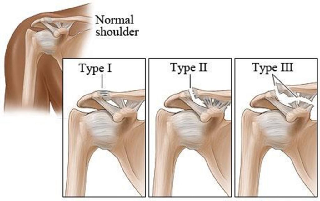 dislocation of the AC joint