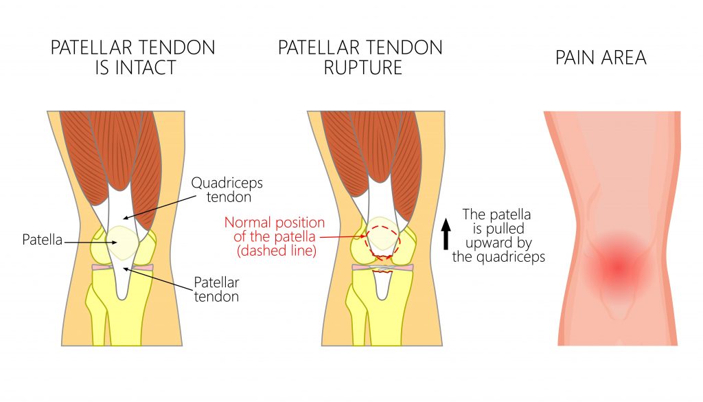 patella-tendon-tear 